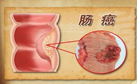 重视危险信号，早期发现大肠癌