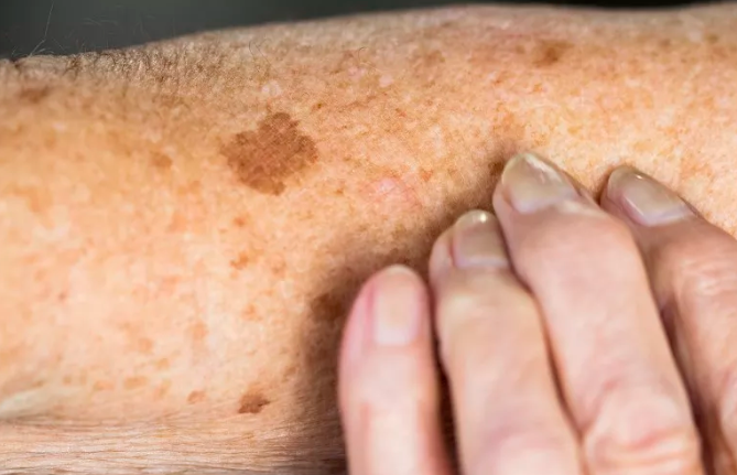 说一说淡化皮肤上的老人斑、黑斑、肝斑的自然疗法